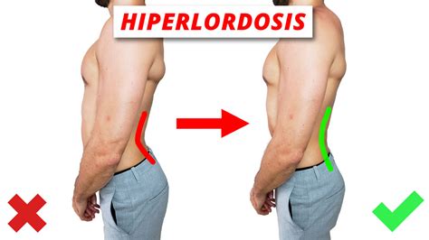 Hiperlordosis lumbar : corregirla con una rutina de 5 min