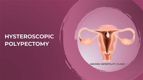 Removal of Uterine Polyp | Hysteroscopic Polypectomy (How is it done ...