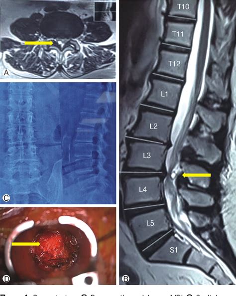 Figure 1 from Ligamentum Flavum Cyst - A Rare Cause of Lumbar Canal ...