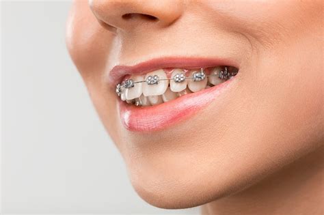 Dental Braces: Types, Procedure, Benefits & Costs