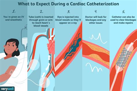 Cardiac Catheterization: Uses, Procedure, Results