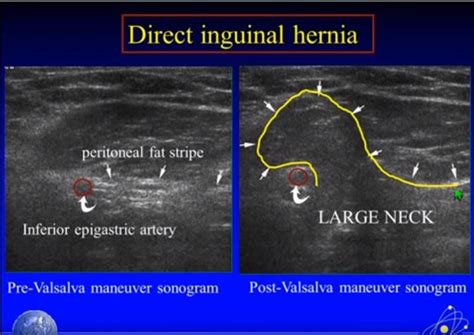 Pin by Stelios Daskalogiannis on hernias- groin | Ultrasound ...