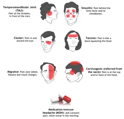 Headache Treatments Cockburn. Common Headaches Types And Triggers ...