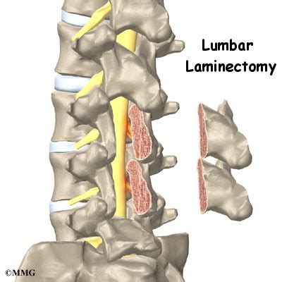 Lumbar Laminectomy - Orthopedic Surgery, Algonquin, IL, Barrington, IL ...