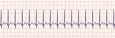 ACLS Rhythm Strips Training and Interpretation