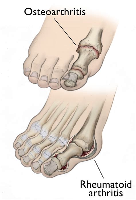 How Arthritis Affects the Feet