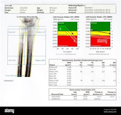 Osteoporosis Bone Density Chart