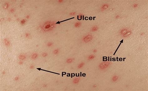 Chicken Pox Disease with Sign, Treatment and Nursing Intervention