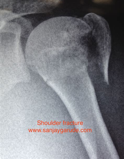 Shoulder Fractures | Dr. Sanjay Garude