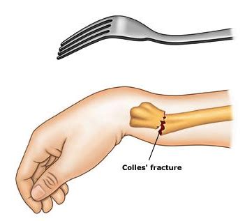 Find 6 Proven Exercises to Heal Your Colles’ (Wrist) Fracture