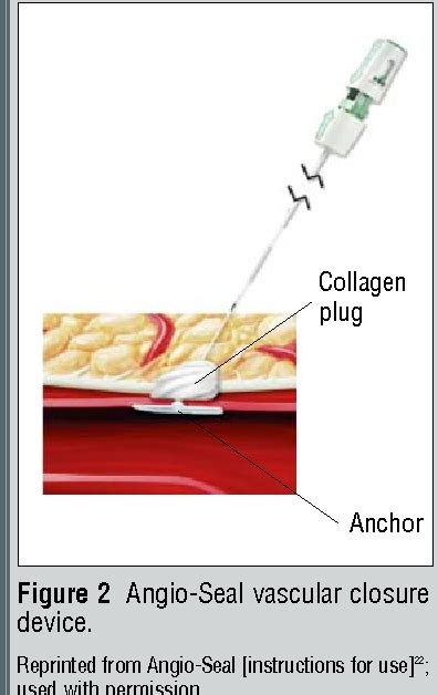 Figure 2 from Complications of femoral artery access during cardiac ...