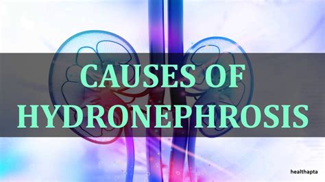 CAUSES OF HYDRONEPHROSIS - YouTube