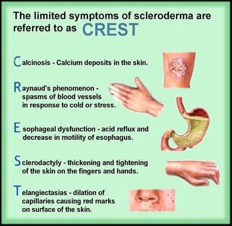 CREST Syndrome, Limited scleroderma | by Jeanette Calara | Medium