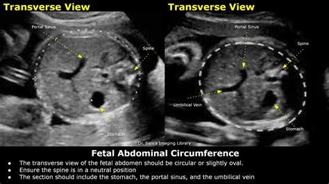 How To Measure Fetal Abdominal Circumference (AC) On Ultrasound | Fetal ...