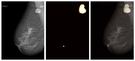 Diagnostics | Free Full-Text | Detecting Abnormal Axillary Lymph Nodes ...