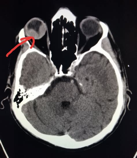 #Head #CT shows a #bleed in the #eye (#choroidal #hemorrhage). # ...