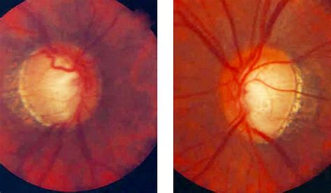 Glaucoma Tests and Diagnosis - Glaucoma Associates of Texas