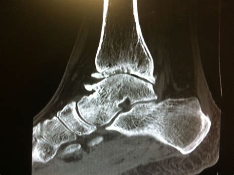 Center for Foot and Ankle Surgery – Foot and Ankle Arthritis