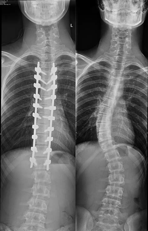 Scoliosis surgery before and after x-rays. : r/pics