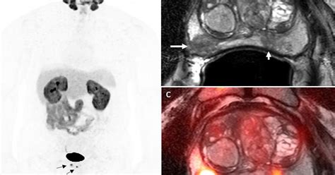 Pilot study: PET imaging might improve prostate cancer diagnosis and ...