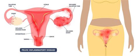 Ovarian Cysts Treatment in Singapore - A/Prof Fong Yoke Fai