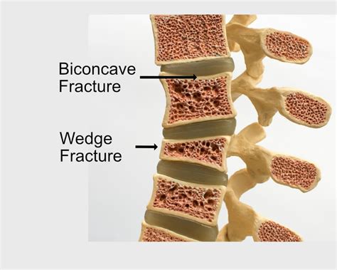 Lumbar Spine Fracture Types - Design Talk