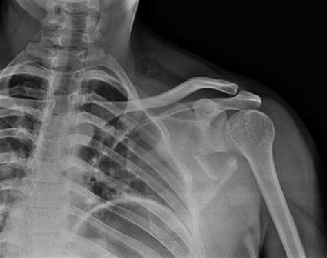 Scapula Fracture - Orthopedics - Medbullets Step 2/3