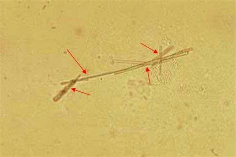 Cytobacteriological examination of urine demonstrating the presence of ...