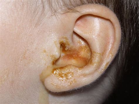 TIPS ON THE CAUSES AND PREVENTIONS OF EAR PUS - Health GadgetsNG