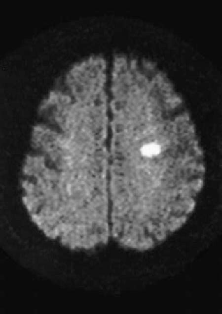 Figure 1 from Isolated Facial Paresis due to a Centrum Ovale Infarction ...