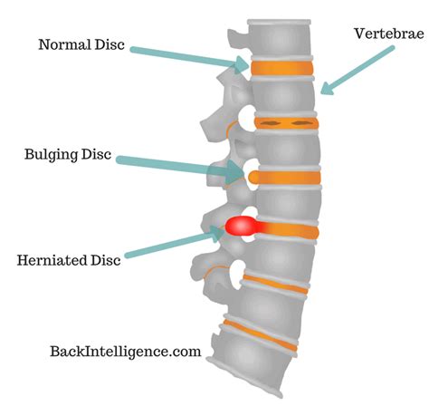 7 Herniated Disc Exercises For Lower Back (Lumbar Area)