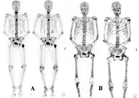 Bone Metastasis Cancer - Symptoms, Life Expectancy, Treatment