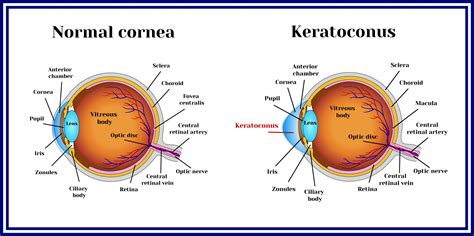 Keratoconus Diagnosis & Treatment | Twenty Twenty Eyecare