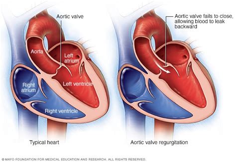 Aortic valve disease - Symptoms and causes - Mayo Clinic