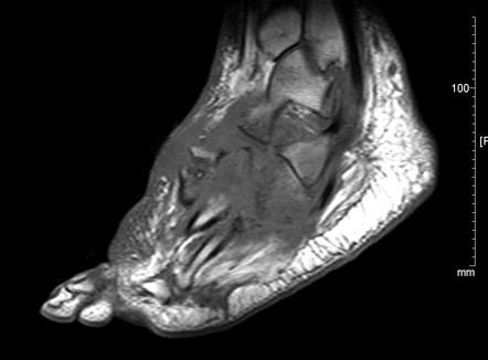 Charcot Arthropathy, Mri Scans By Zephyr | lupon.gov.ph