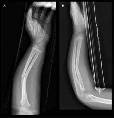 Greenstick Fracture - Definition, Causes and Treatment