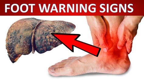 12 SIGNS Your Feet Are Telling You That Your LIVER has PROBLEMS - YouTube