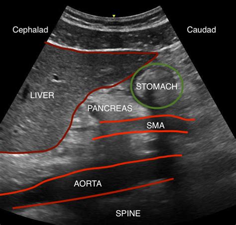 [Figure, Gastric ultrasound anatomy, including liver,...] - StatPearls ...