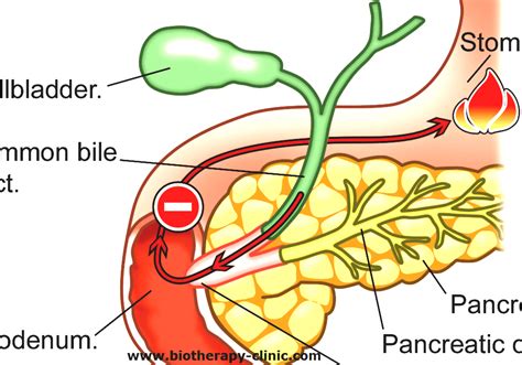 Biliary Reflux - Bile Reflux Cure