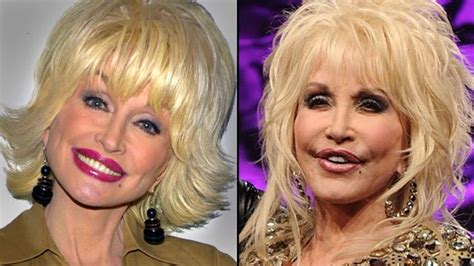 Dolly Parton Plastic Surgery She Has Been Bold Enough To Confirm Some ...