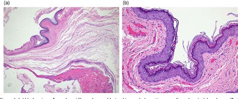 Figure 5 from Case report of complicated epidermoid cyst of the floor ...