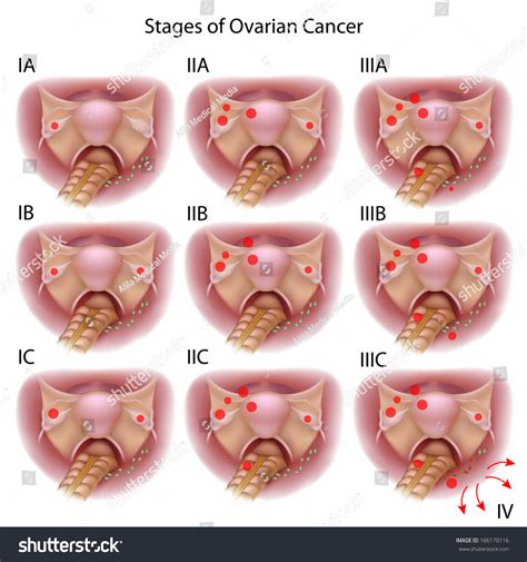 Stages Epithelial Ovarian Cancer Stock Illustration 166170116 ...