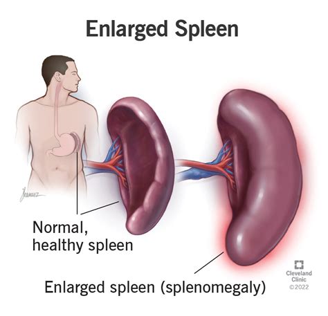 Normal And Enlarged Spleen