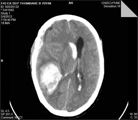 e A non-contrast enhanced CT scan of the head showing a large bleed in ...