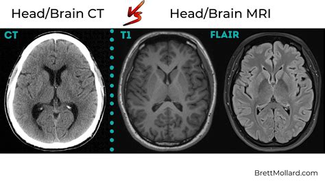 CT Scan vs MRI: What's the Difference?