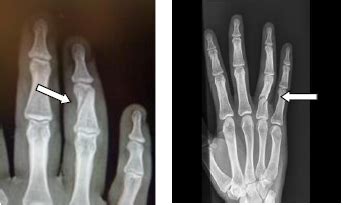 Proximal / Middle phalanx fractures | CUH