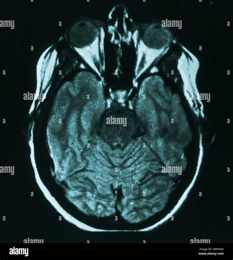 MRI scan (axial view) through the brain of a 31 year old female. The ...