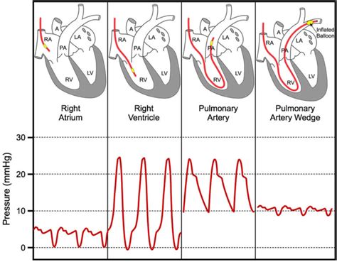 Pulmonary capillary wedge pressure & pulmonary artery wedge pressure