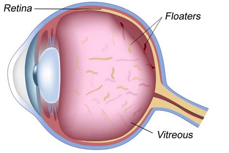 Different Types of Eye Floaters - What Causes Them? - The Eye News