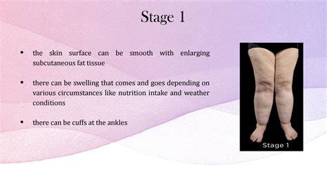 What are the Different Stages of Lipedema? by lipedematips - Issuu